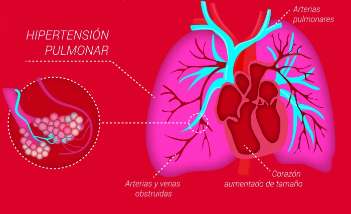 Pulmones y corazón enfermos de hipertensión pulmonar