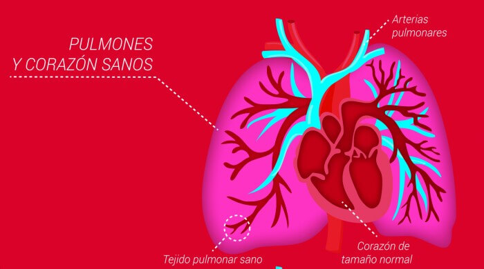 Pulmones y corazón sin hipertensión pulmonar